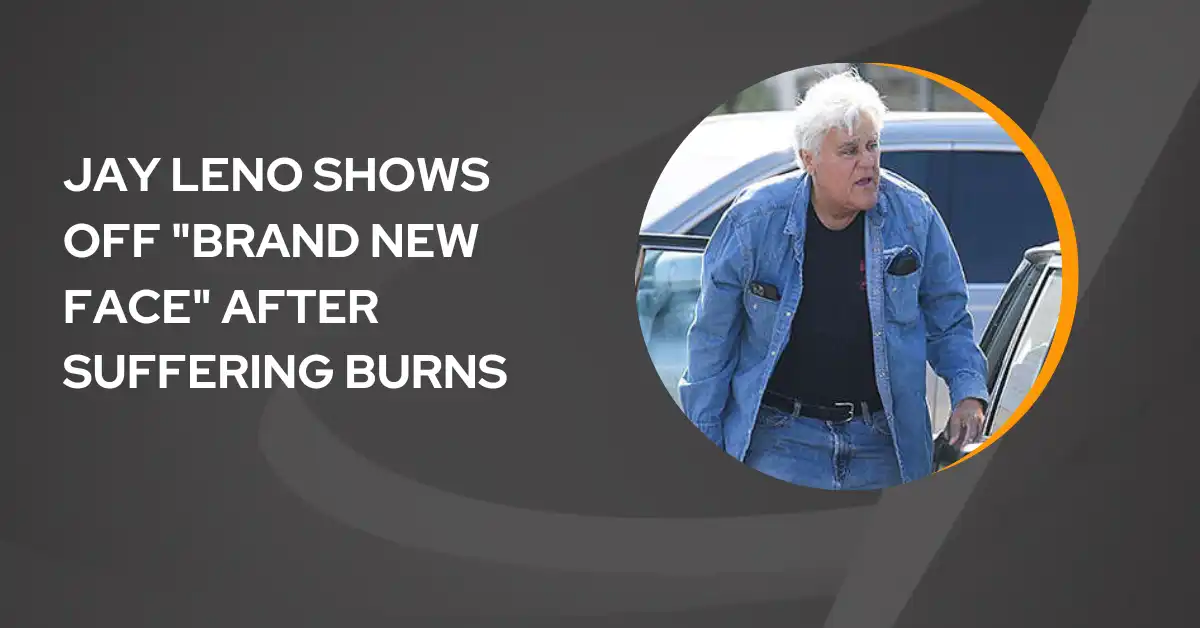 Jay Leno Shows Off Brand New Face After Suffering Burns